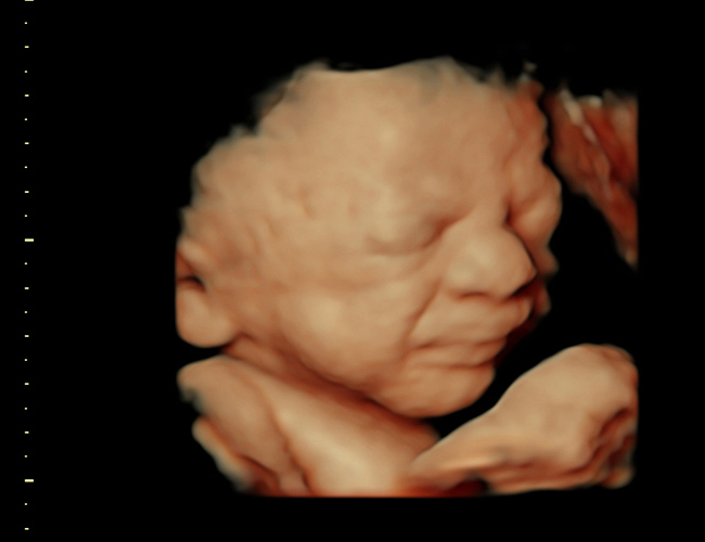 3D ultrasound image at 31 weeks
